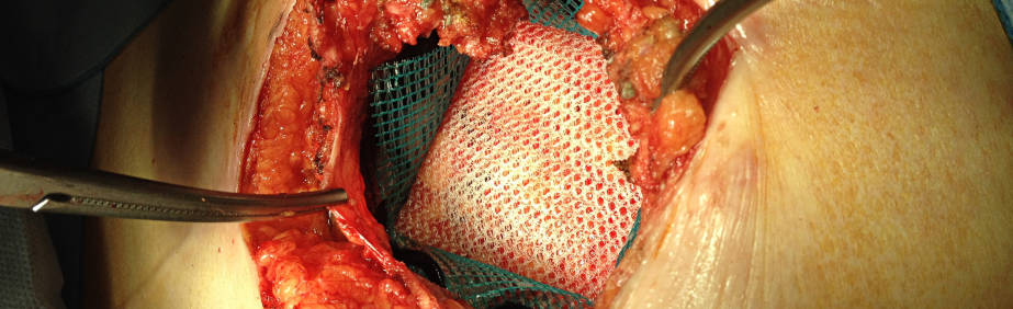 hernioplastia umbilical